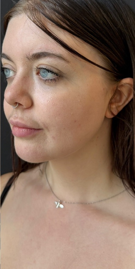 Patient after Chin Liposuction