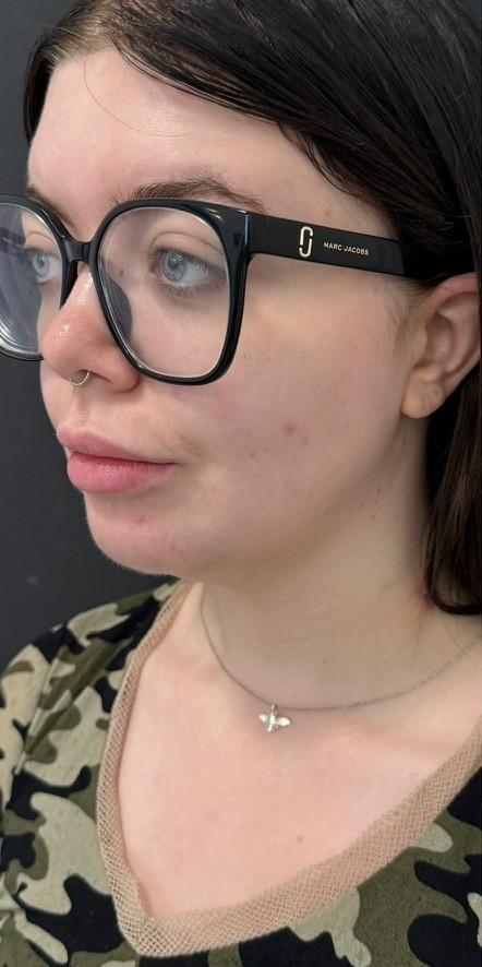 Patient before Chin Liposuction