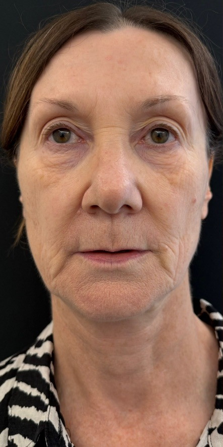 Patient before Facelift