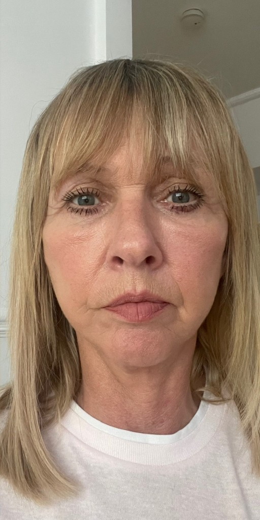 Patient after Facelift