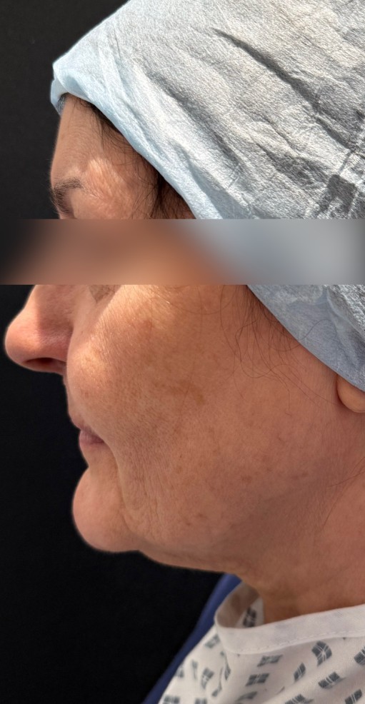Patient before Facelift