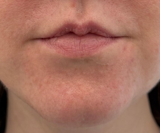 Patient before Lip Lift