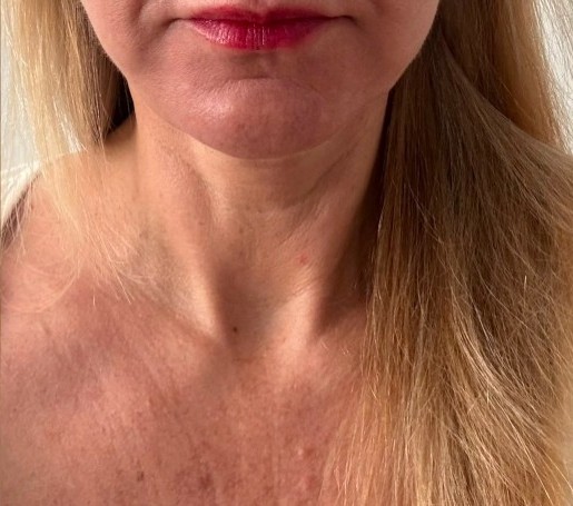 Patient after Neck Lift