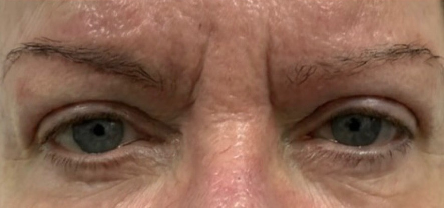 Patient after Upper Blepharoplasty