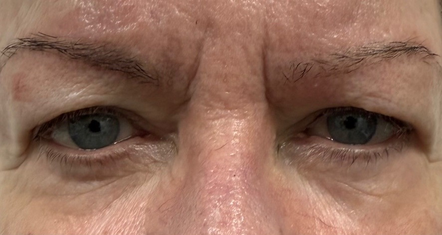 Patient before Upper Blepharoplasty